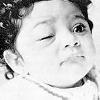 Child with sign of Romana on right eye. This is the site of infection of Chagas' disease. U. S. Armed Forces Institute of Pathology