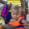 126 Note Reddish Hair, One Sign of Kwashiorkor. Distended Belly is Another Sign.
Kwashiorkor is Caused by Lack of Adequate Protein in the Child's Diet