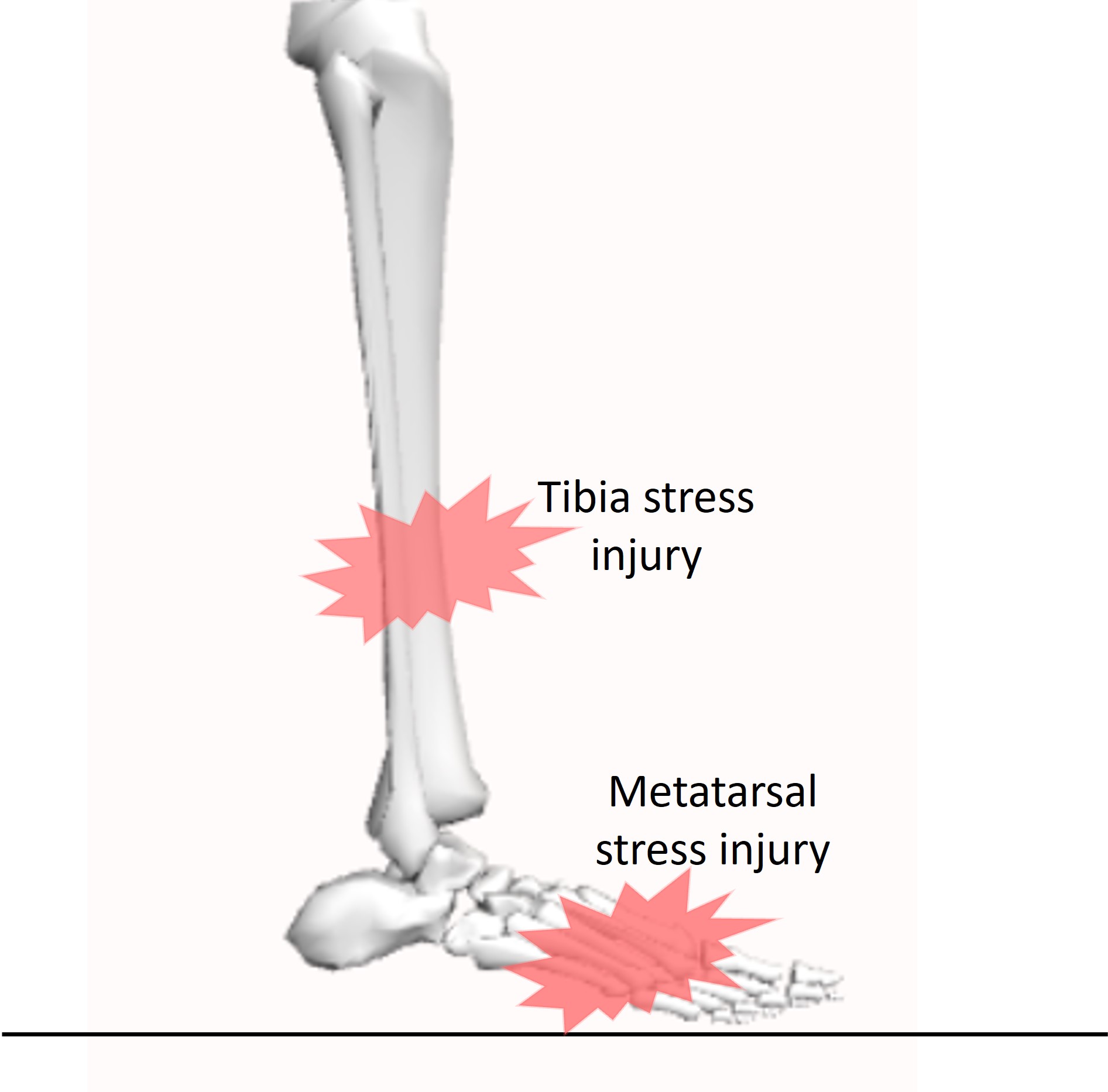 Bone stress injuries