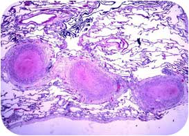 Lung Granulomas