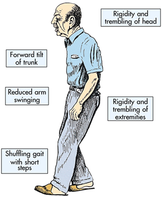 Drawing of an elderly man with text describing signs of Parkinson's (described in the article).