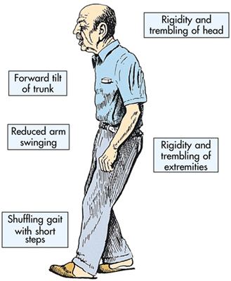 Signs of Parkinson's Disease Drawing of an elderly man with text describing signs of Parkinson's (described in the article).